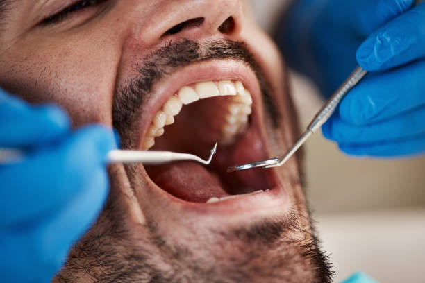 Best Emergency Tooth Extraction in Vidor, TX